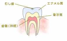 CO（初期の虫歯）