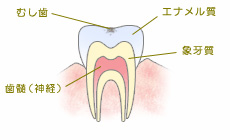 CO（初期の虫歯）