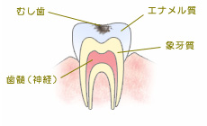 C1（エナメル質の虫歯）