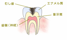 C2（象牙質の虫歯）