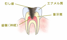 C3（神経まで進行した虫歯）