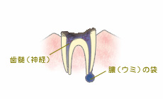 C4（末期の虫歯）